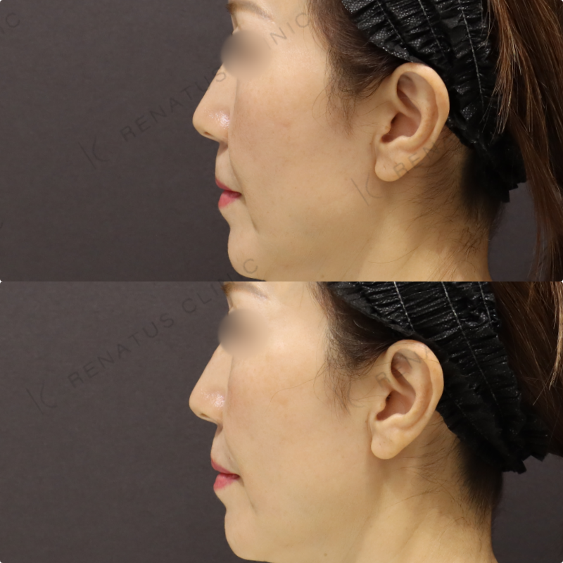 鼻翼基部・ほうれい線ヒアルロン酸症例写真