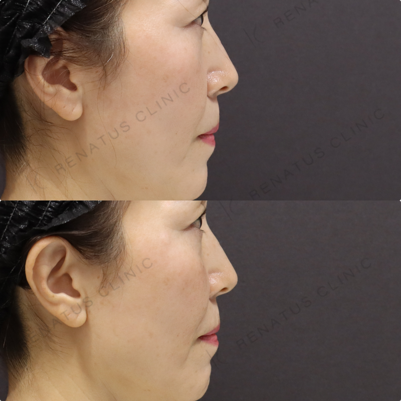 鼻翼基部・ほうれい線ヒアルロン酸症例写真