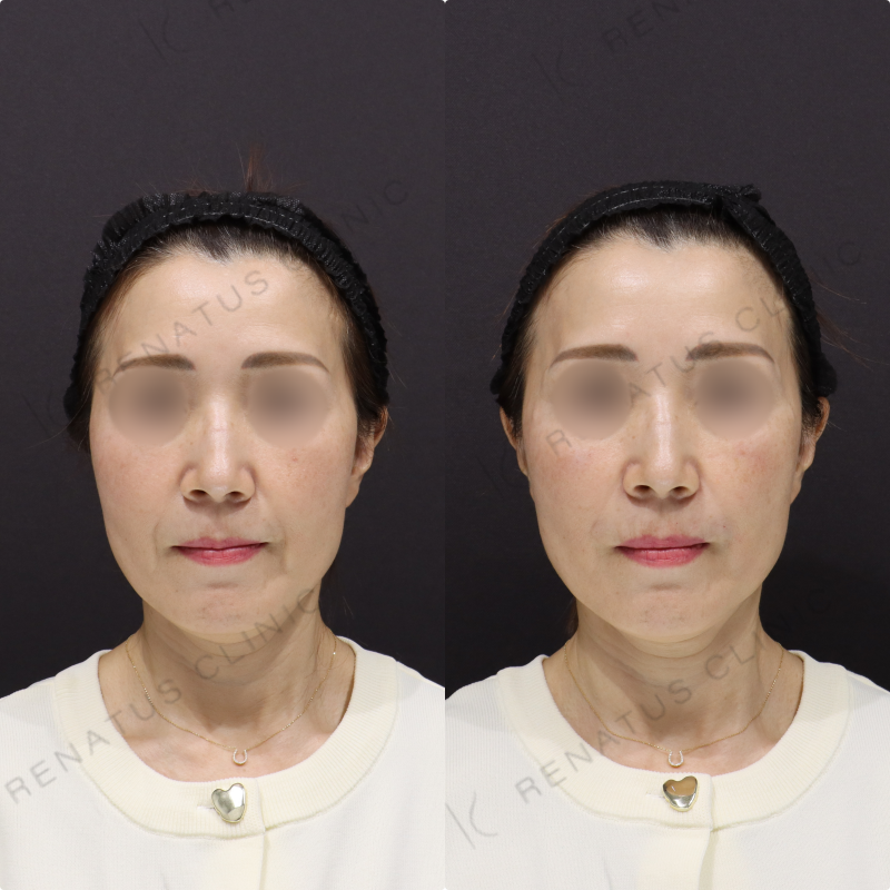 鼻翼基部・ほうれい線ヒアルロン酸症例写真