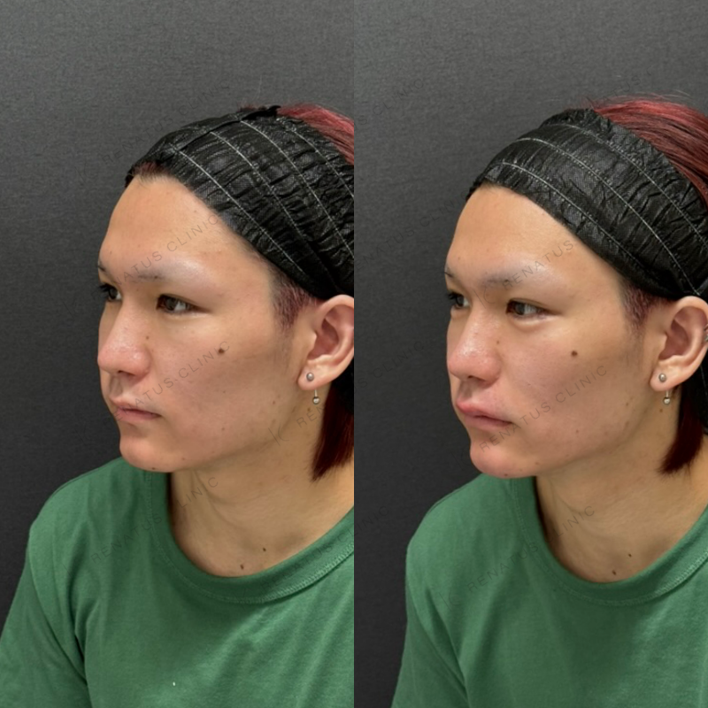 福岡_85_松村Dr_涙袋・唇_ボルベラ_男性_20_斜め左- 涙袋・唇ヒアルロン酸ボルベラ症例写真
