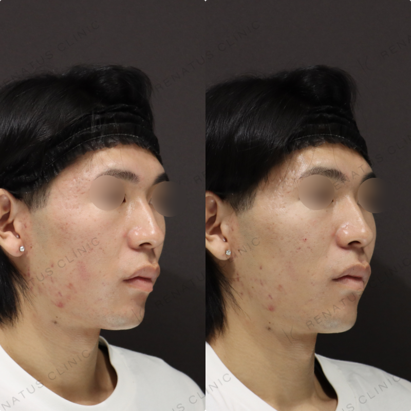 ゴルゴラインヒアルロン酸症例写真 ゴルゴラインヒアルロン酸症例写真