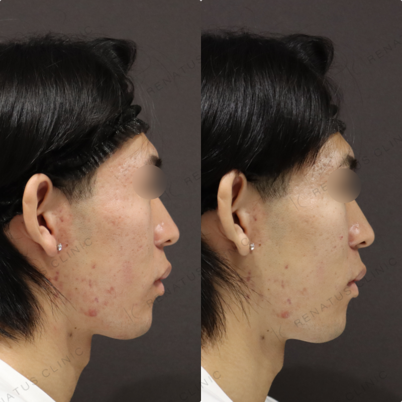 ゴルゴラインヒアルロン酸症例写真 ゴルゴラインヒアルロン酸症例写真