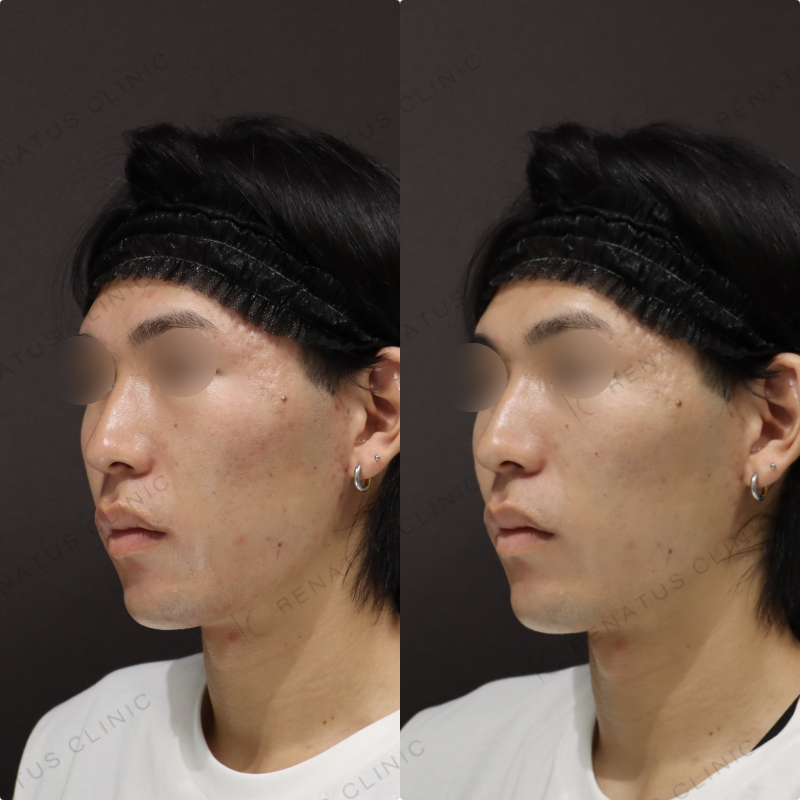 ゴルゴラインヒアルロン酸症例写真 ゴルゴラインヒアルロン酸症例写真