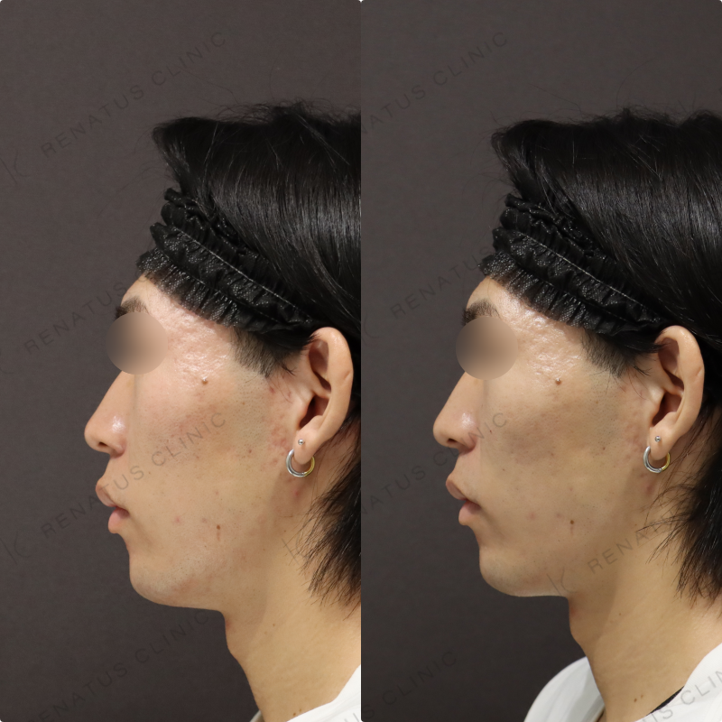 ゴルゴラインヒアルロン酸症例写真 ゴルゴラインヒアルロン酸症例写真