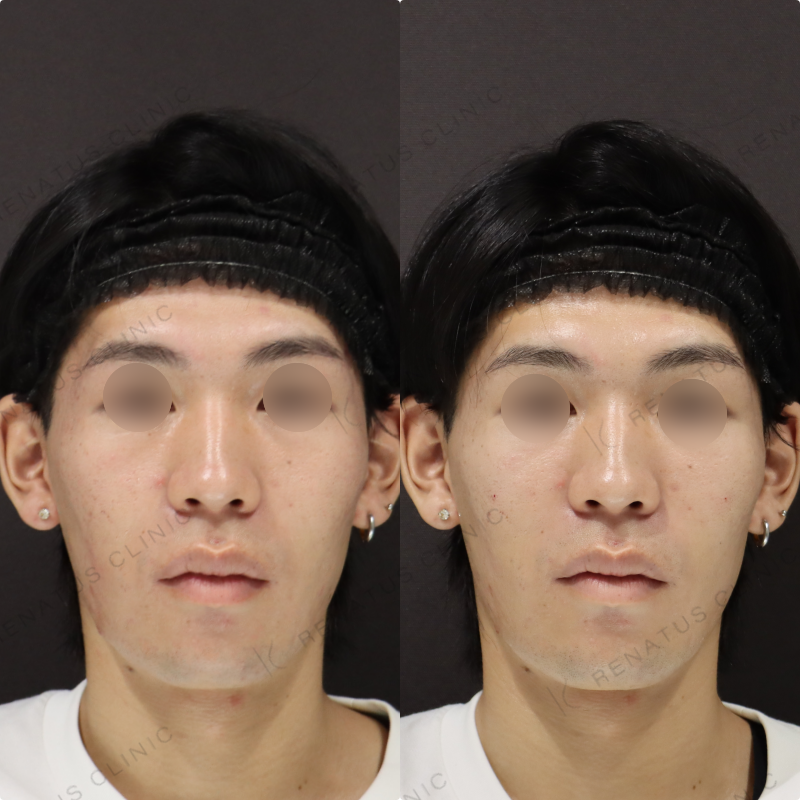 ゴルゴラインヒアルロン酸症例写真 ゴルゴラインヒアルロン酸症例写真