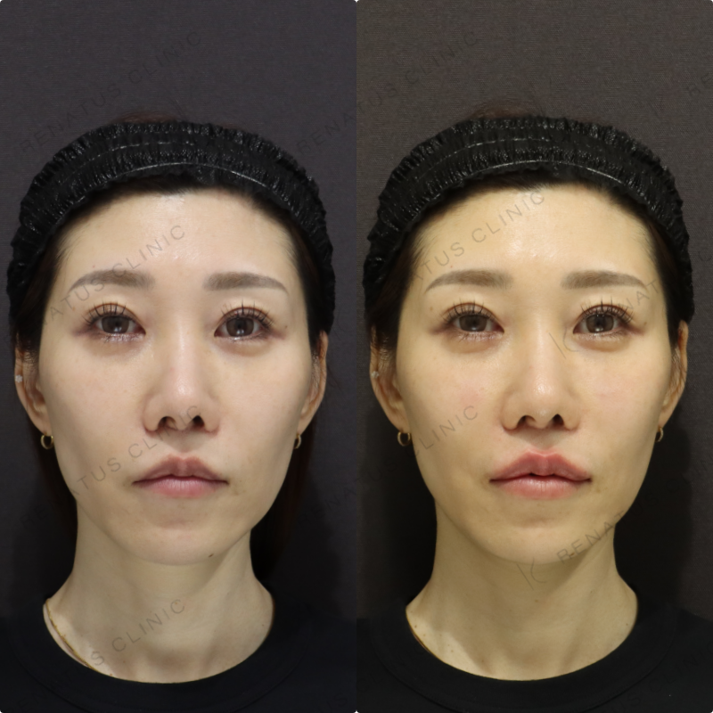 上唇ヒアルロン酸症例写真 上唇ヒアルロン酸症例写真