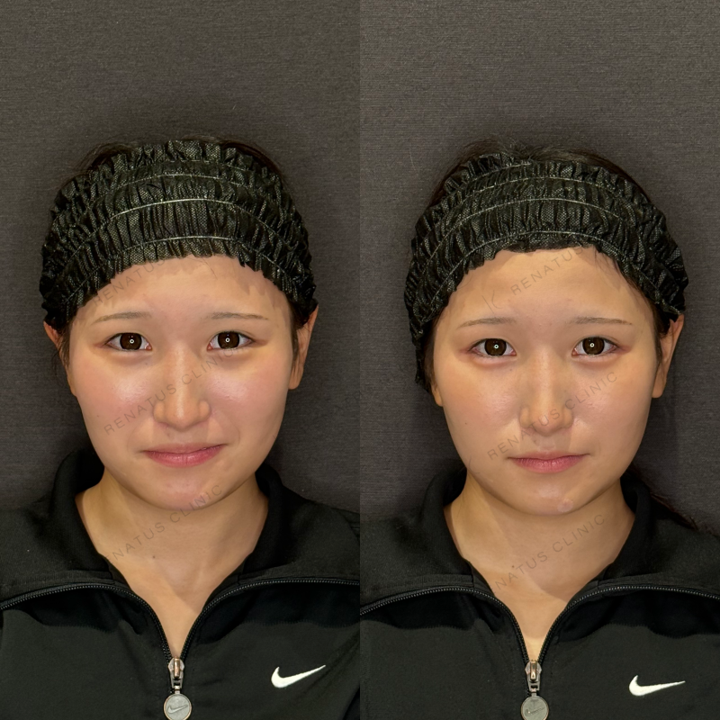 涙袋ヒアルロン酸ボルベラ症例写真 涙袋ヒアルロン酸ボルベラ症例写真