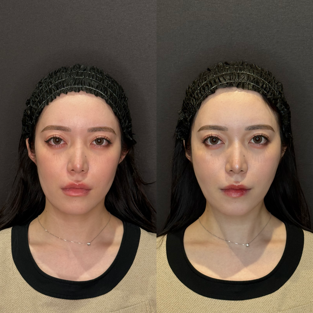 名古屋の糸リフトが安い人気のモニター 名古屋の糸リフトが安い人気のモニター