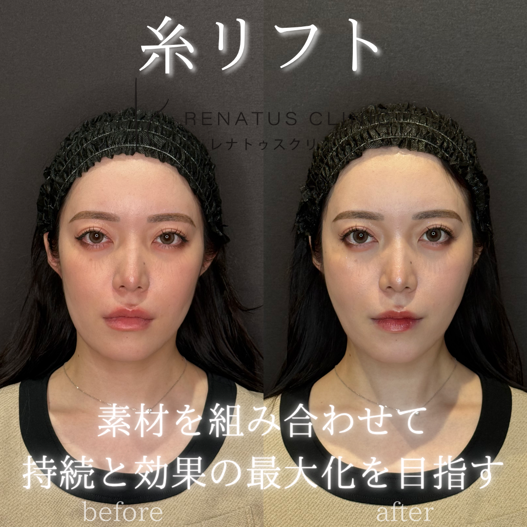 名古屋の糸リフトが安い人気のモニター 名古屋の糸リフトが安い人気のモニター