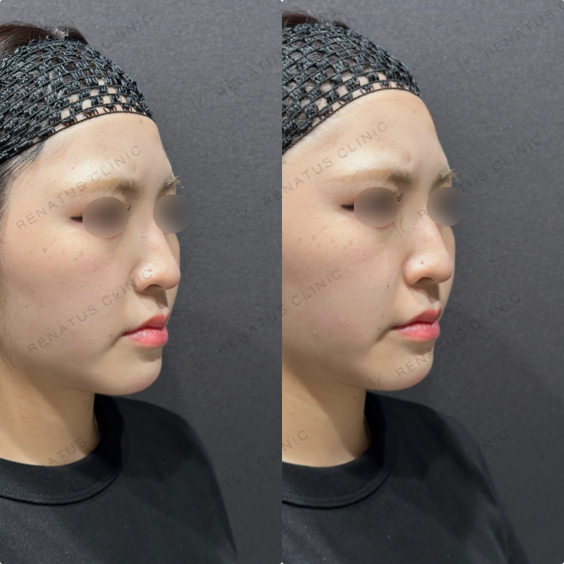 ほうれい線ヒアルロン酸ダイヤモンドフィール症例写真