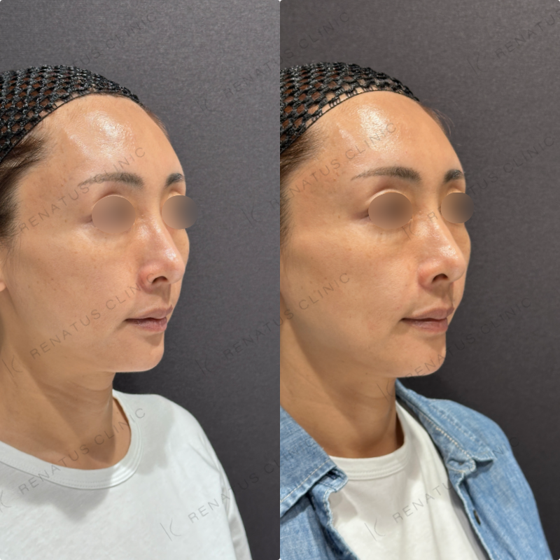 ほうれい線ヒアルロン酸ダイヤモンドフィール症例写真