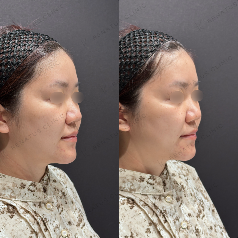 ほうれい線ヒアルロン酸ダイヤモンドフィール症例写真