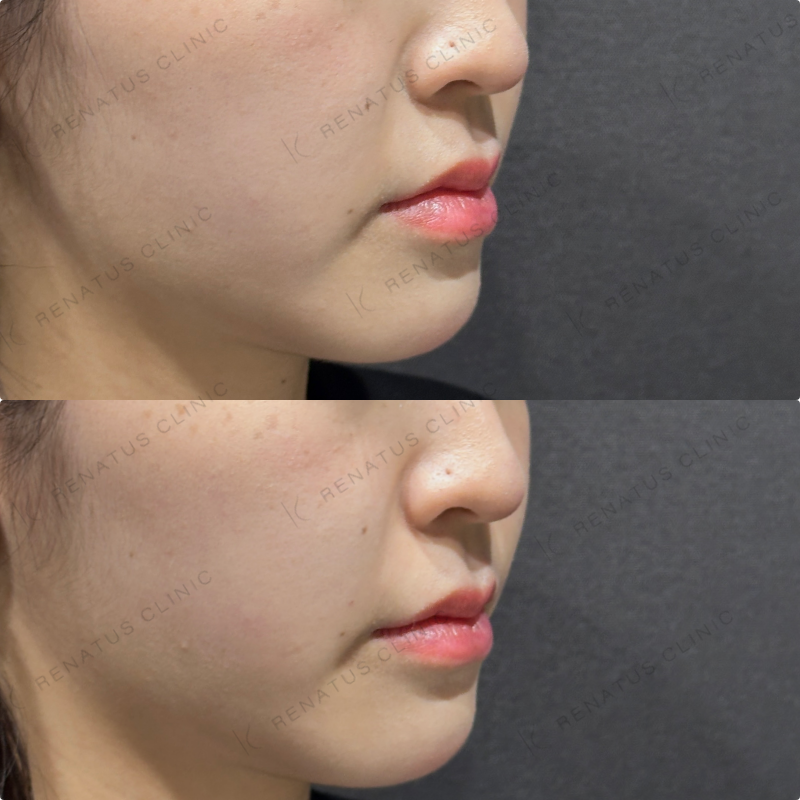 ほうれい線ヒアルロン酸ダイヤモンドフィール症例写真