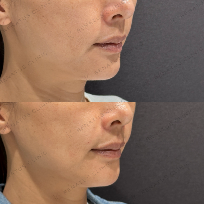 ほうれい線ヒアルロン酸ダイヤモンドフィール症例写真