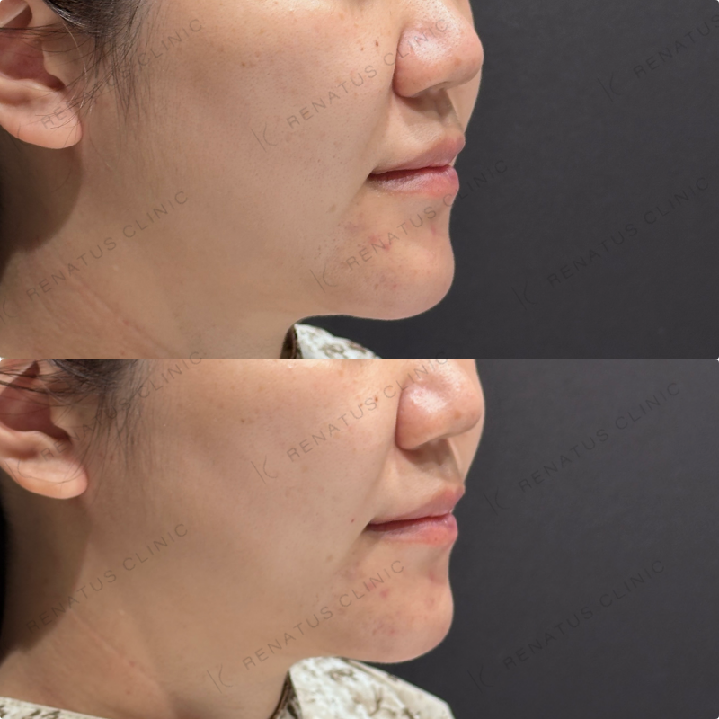 ほうれい線ヒアルロン酸ダイヤモンドフィール症例写真