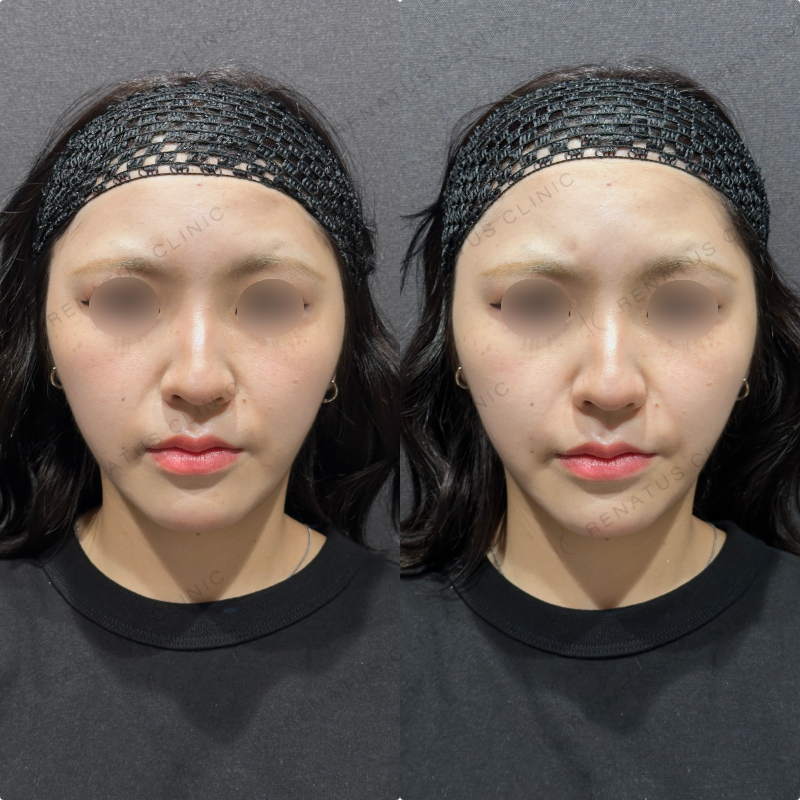 ほうれい線ヒアルロン酸ダイヤモンドフィール症例写真