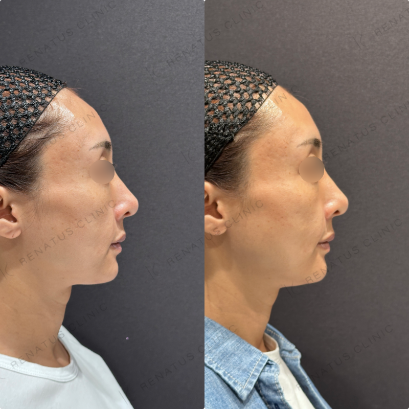 ほうれい線ヒアルロン酸ダイヤモンドフィール症例写真