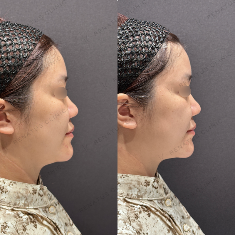 ほうれい線ヒアルロン酸ダイヤモンドフィール症例写真