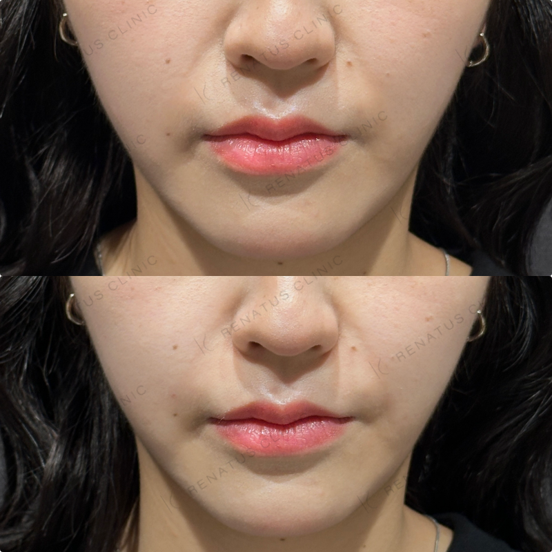 ほうれい線ヒアルロン酸ダイヤモンドフィール症例写真