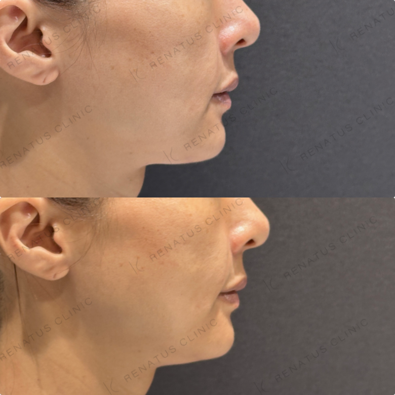 ほうれい線ヒアルロン酸ダイヤモンドフィール症例写真