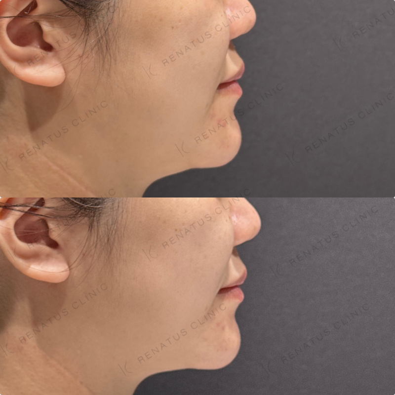 ほうれい線ヒアルロン酸ダイヤモンドフィール症例写真