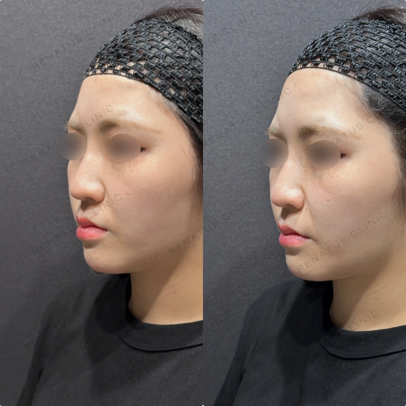 ほうれい線ヒアルロン酸ダイヤモンドフィール症例写真