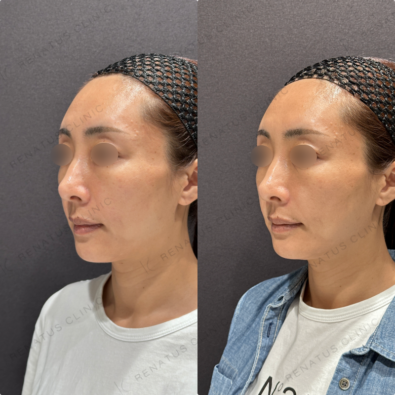 ほうれい線ヒアルロン酸ダイヤモンドフィール症例写真