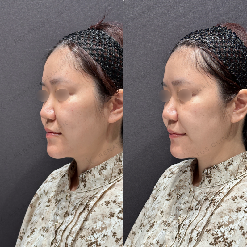 ほうれい線ヒアルロン酸ダイヤモンドフィール症例写真