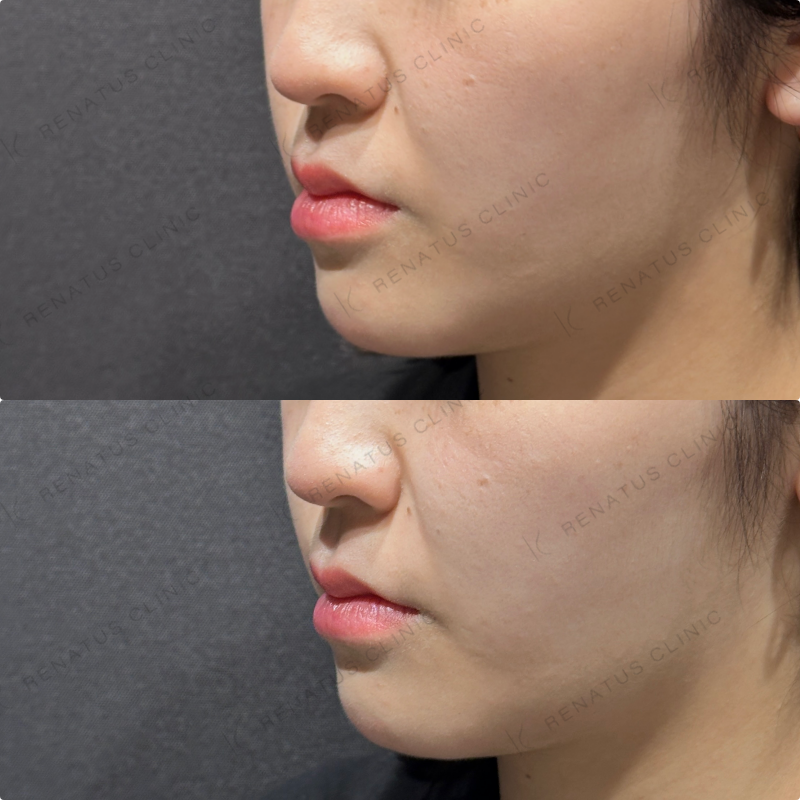 ほうれい線ヒアルロン酸ダイヤモンドフィール症例写真