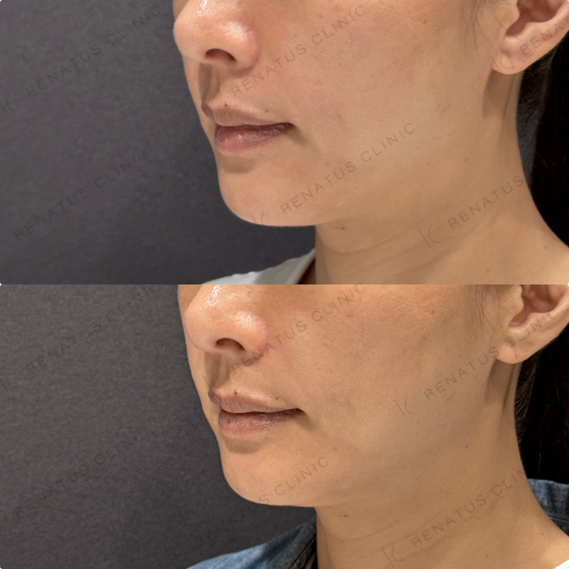 ほうれい線ヒアルロン酸ダイヤモンドフィール症例写真