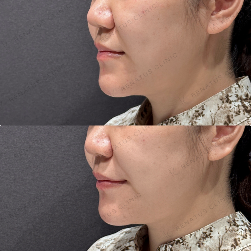 ほうれい線ヒアルロン酸ダイヤモンドフィール症例写真