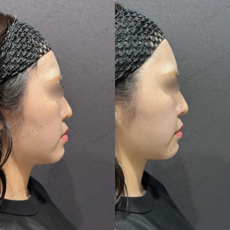 ほうれい線ヒアルロン酸ダイヤモンドフィール症例写真