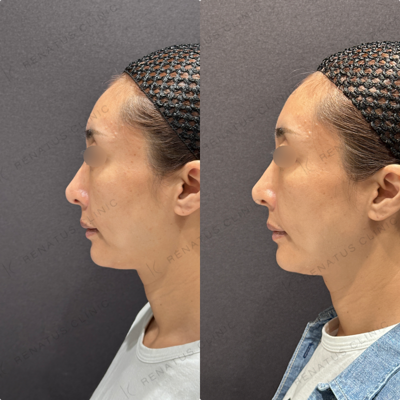 ほうれい線ヒアルロン酸ダイヤモンドフィール症例写真