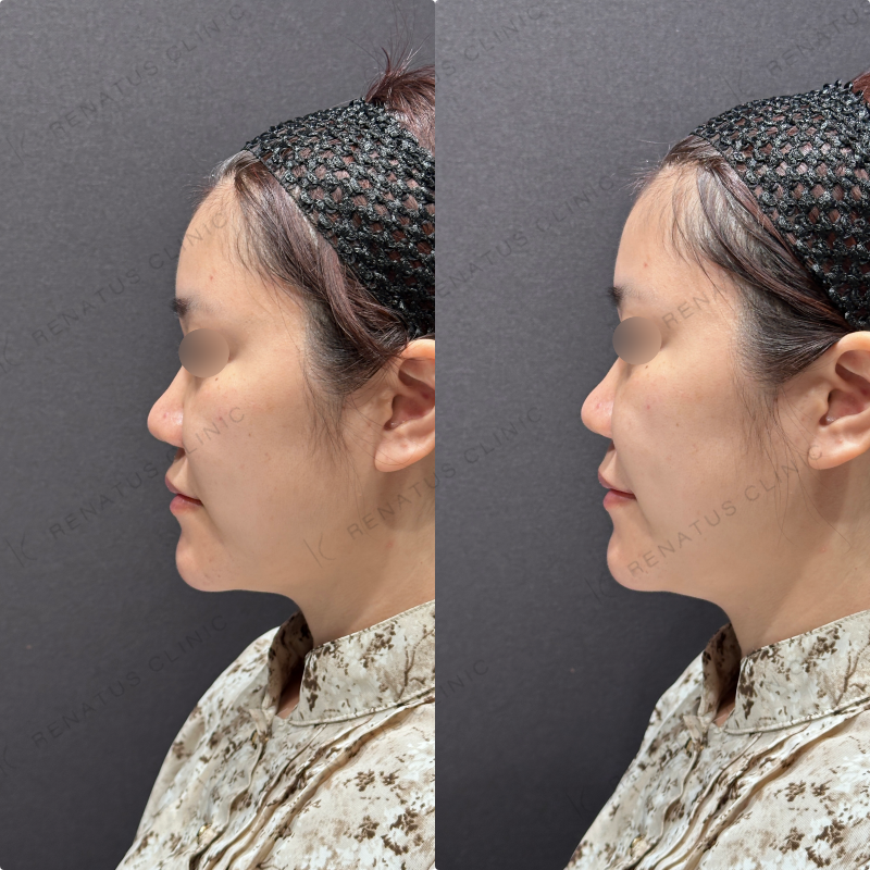 ほうれい線ヒアルロン酸ダイヤモンドフィール症例写真