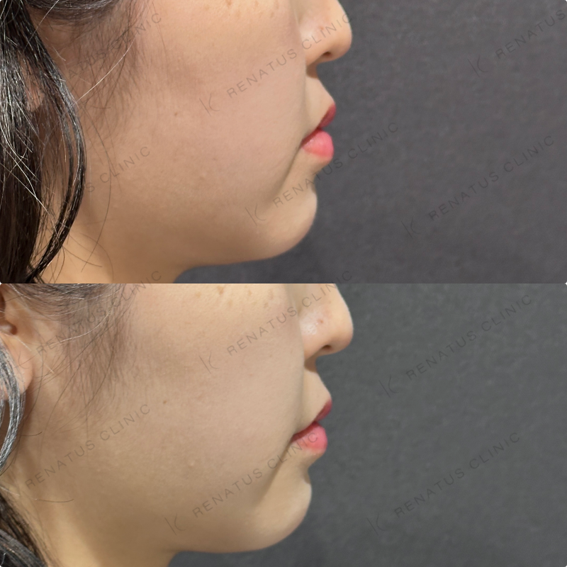 ほうれい線ヒアルロン酸ダイヤモンドフィール症例写真