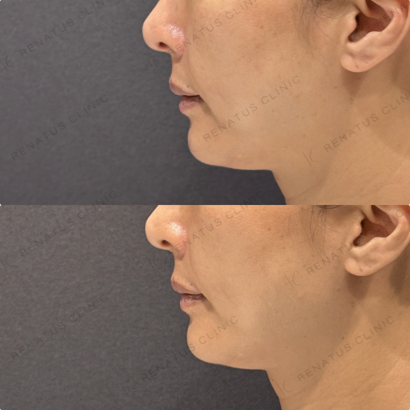 ほうれい線ヒアルロン酸ダイヤモンドフィール症例写真