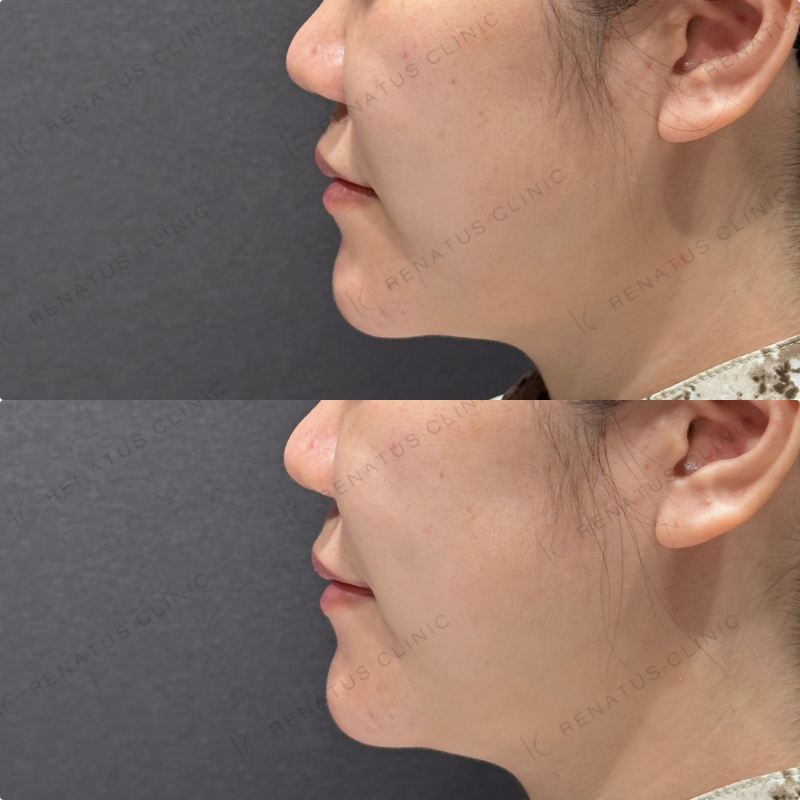 ほうれい線ヒアルロン酸ダイヤモンドフィール症例写真