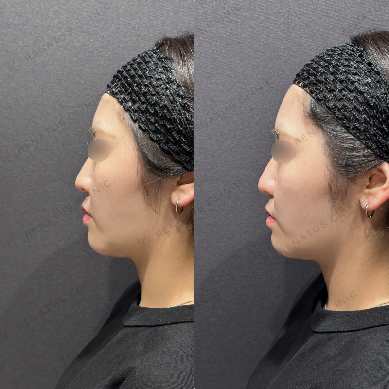 ほうれい線ヒアルロン酸ダイヤモンドフィール症例写真