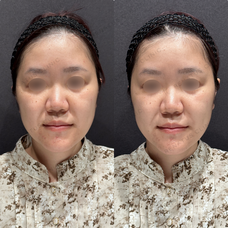 ほうれい線ヒアルロン酸ダイヤモンドフィール症例写真