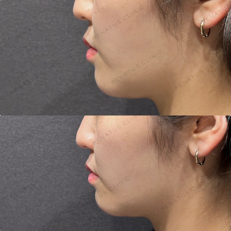 ほうれい線ヒアルロン酸ダイヤモンドフィール症例写真