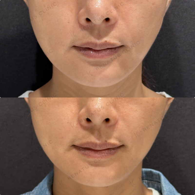 ほうれい線ヒアルロン酸ダイヤモンドフィール症例写真