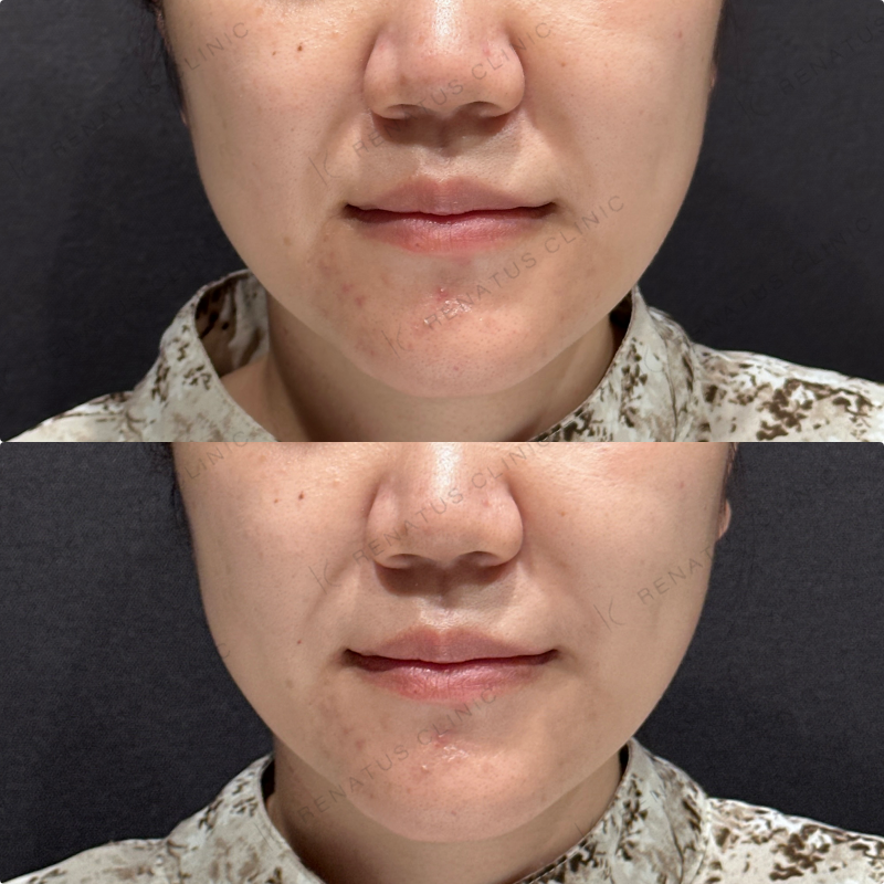 ほうれい線ヒアルロン酸ダイヤモンドフィール症例写真