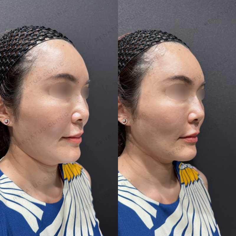 ほうれい線ヒアルロン酸ボリフト症例写真