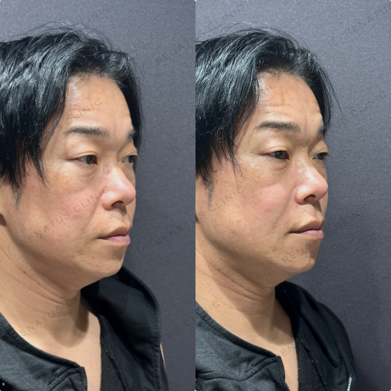 ほうれい線ヒアルロン酸ボリフト症例写真