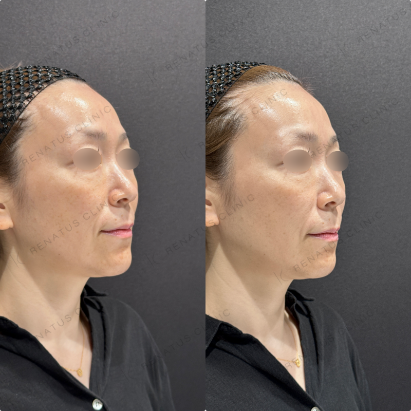 ほうれい線ヒアルロン酸ボリフト症例写真