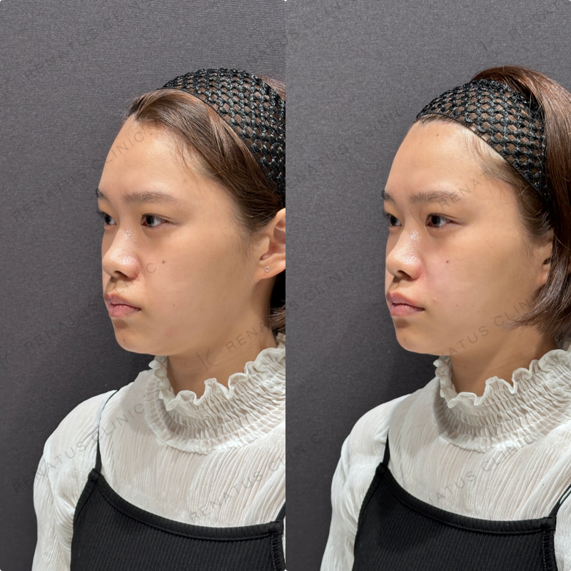 ほうれい線ヒアルロン酸ボリフト症例写真