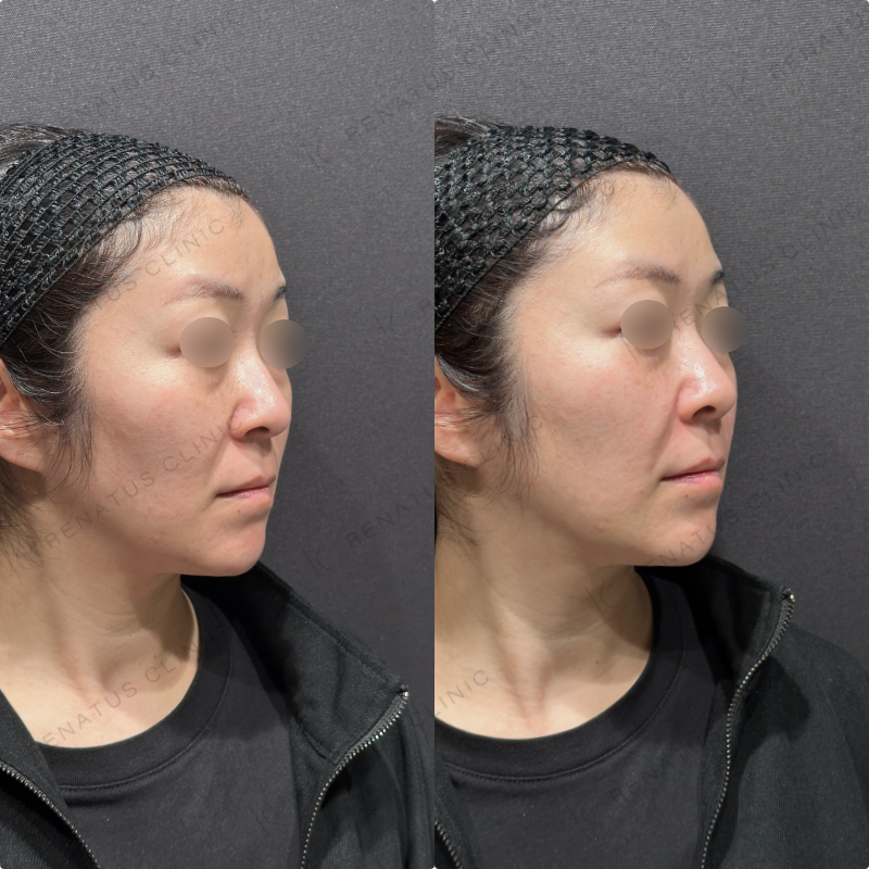 ほうれい線ヒアルロン酸ボリフト症例写真