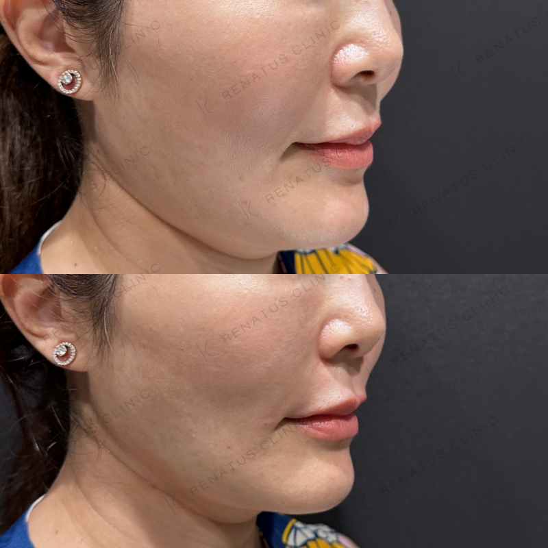 ほうれい線ヒアルロン酸ボリフト症例写真