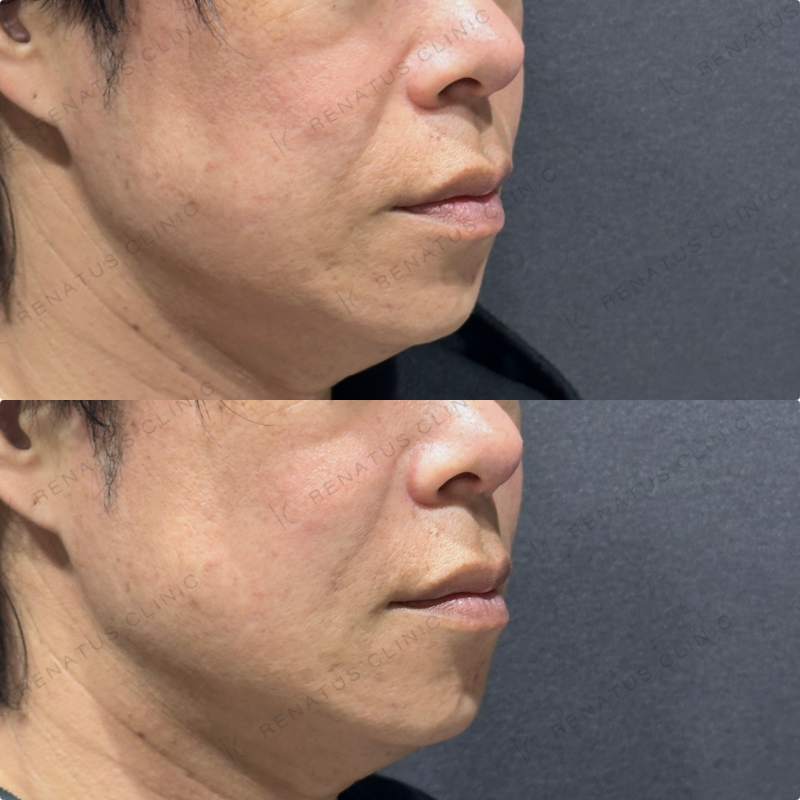 ほうれい線ヒアルロン酸ボリフト症例写真