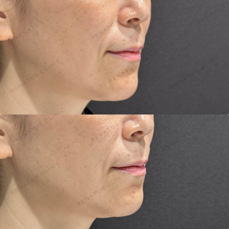 ほうれい線ヒアルロン酸ボリフト症例写真